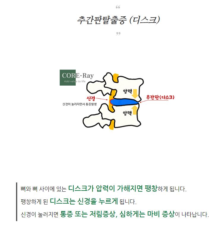 메드랩 코어레이 전동식 정형용 견인 의료기기 이미지 2